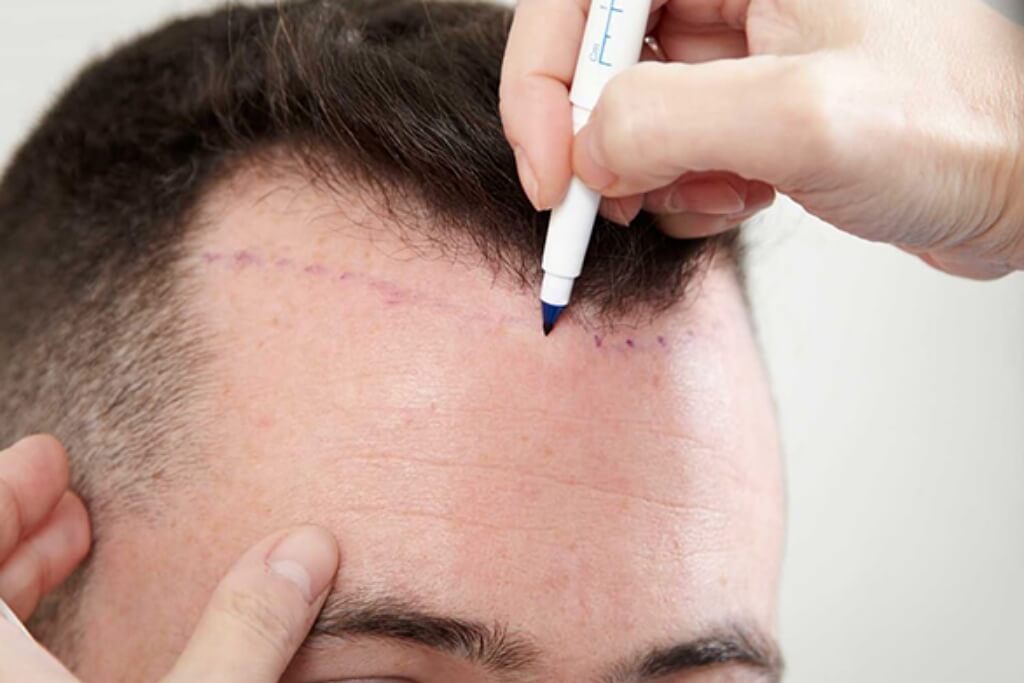 how to perform a hair transplant