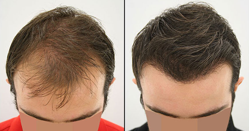 hair transplant step by step process