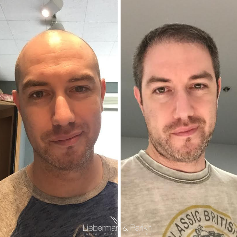 hair transplant before after