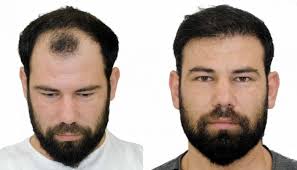 greffe de cheveux avant après photos et exemples