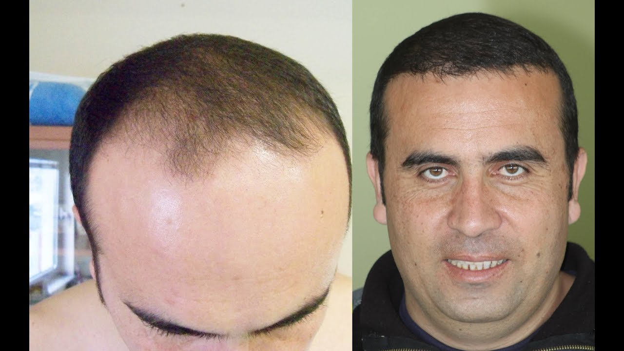 natural hair transplant before after results