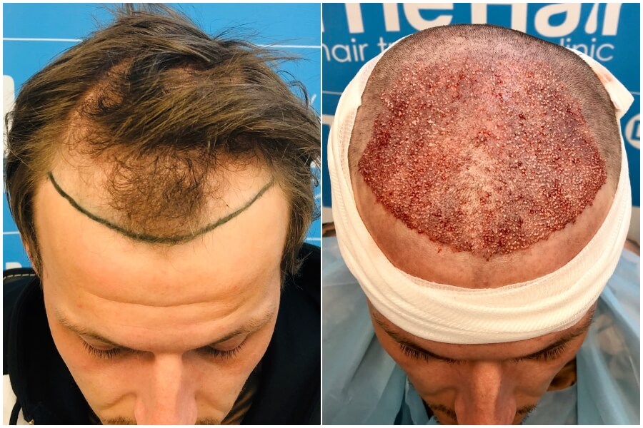 Haartransplantation vor nach Fotos