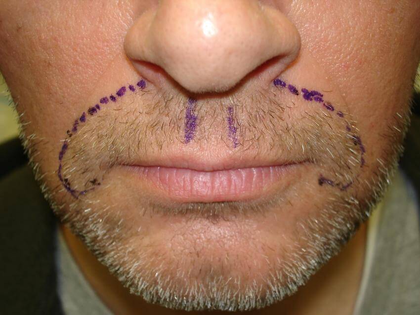 nach Mustachetransplantation