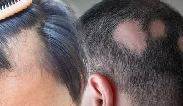 trattamento dell'alopecia areata areata