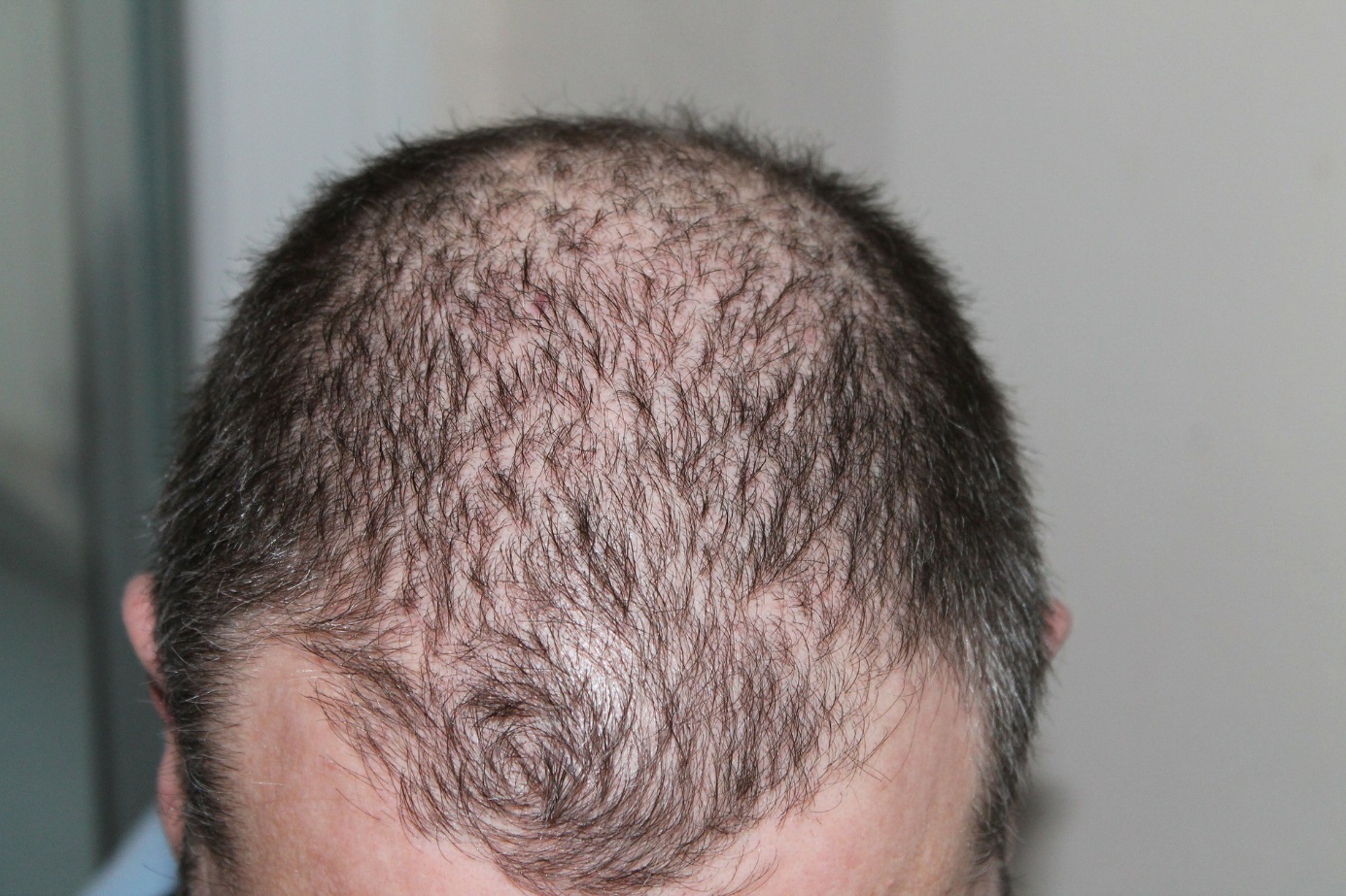 bad hair transplant beforeafter