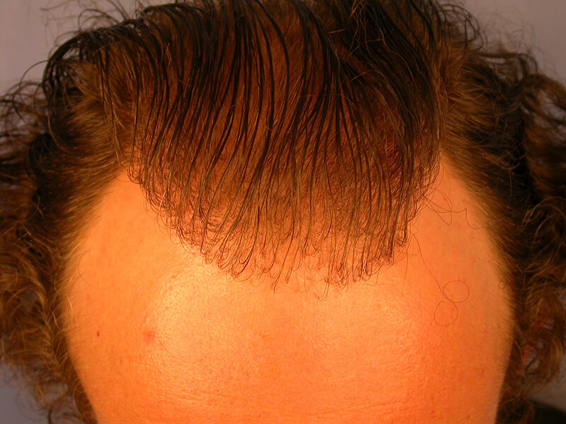 Beispiele für schlechte Haartransplantationen