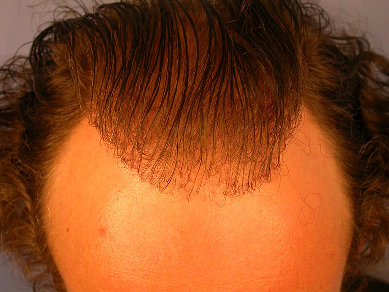 bad hair transplant examples