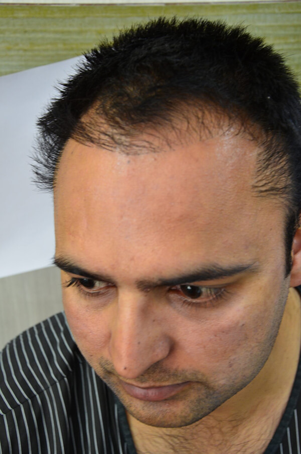 bad hair transplant result