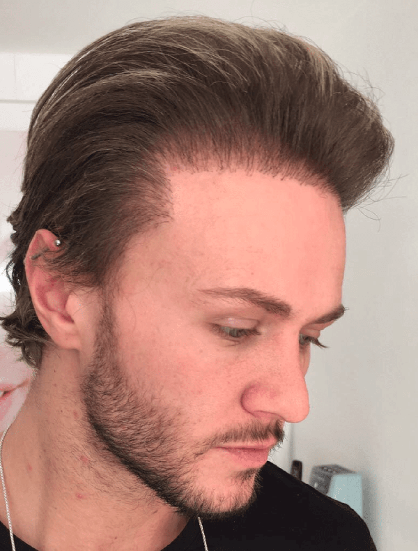 bad hair transplant_7