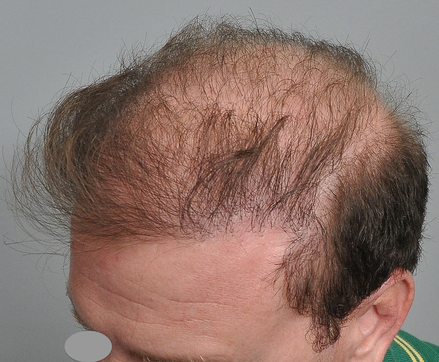 trasplante de cabello malo