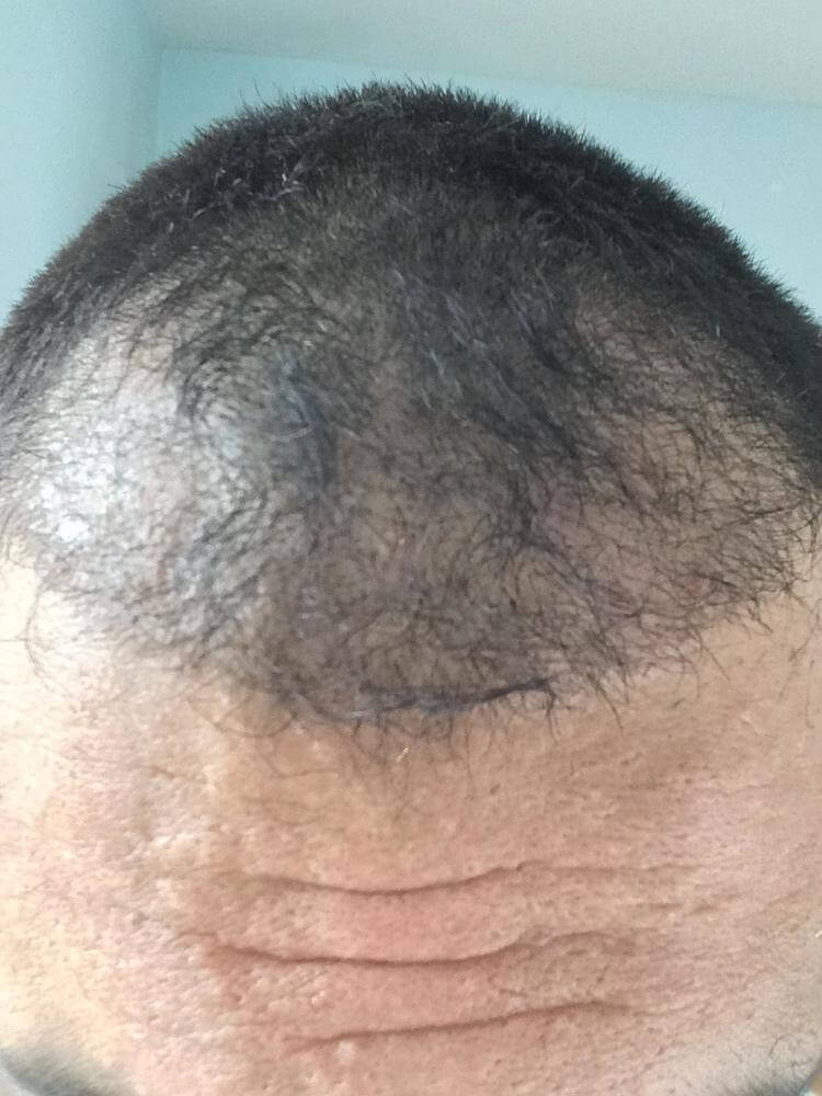 bad hairtransplant before after