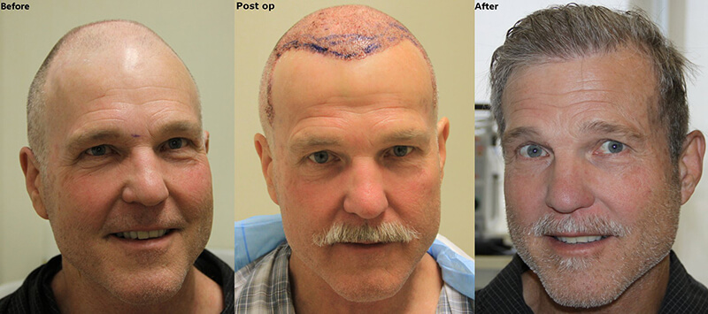 kahle Haartransplantation mittleren Alters vorher nachher