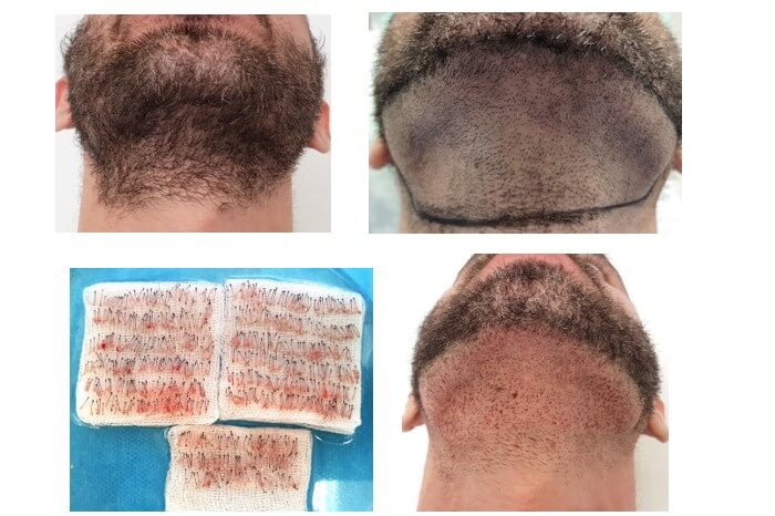 Trasplante de cabello de barba a cabeza