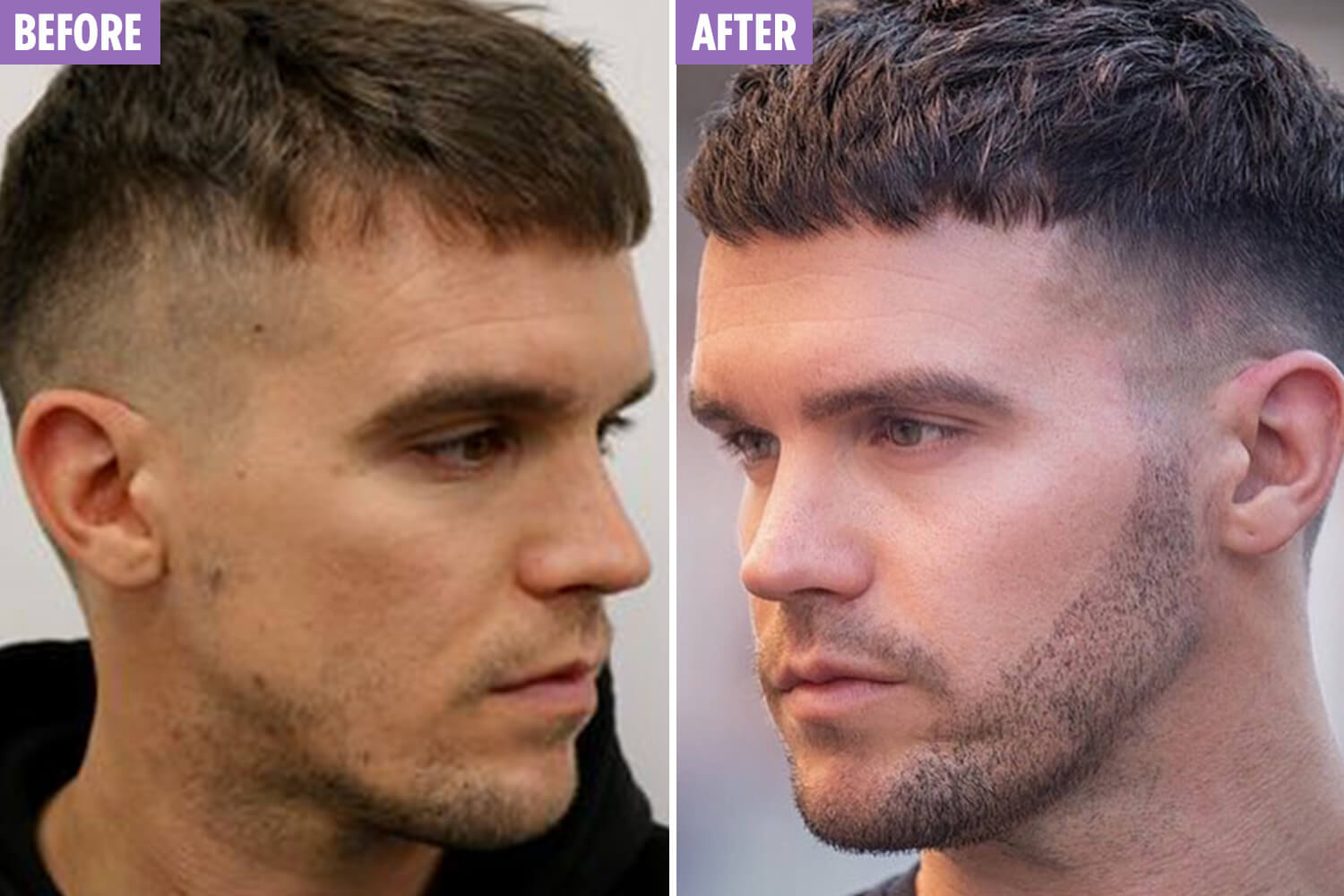 trasplante de barba antes y después
