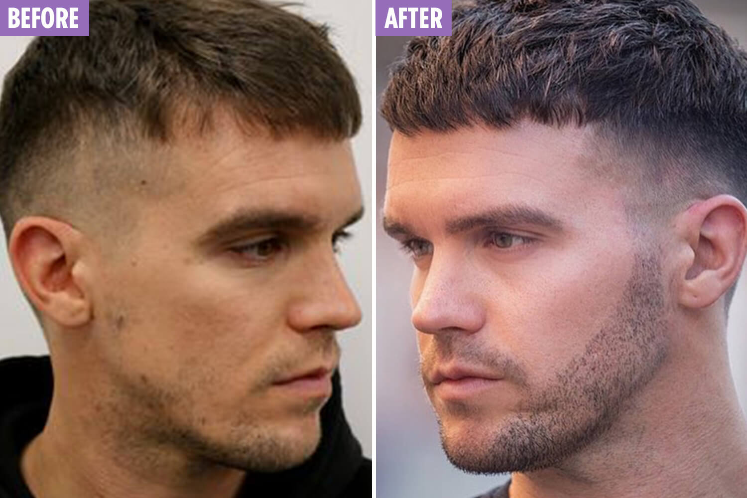 beard transplant before and after