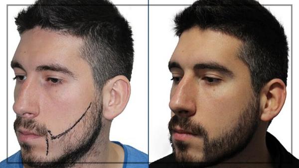 beard transplant prices