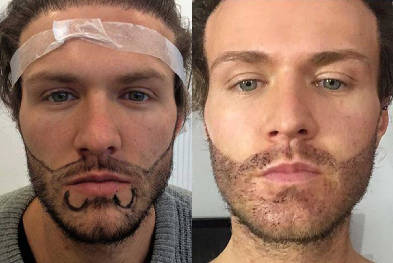 beard transplant result