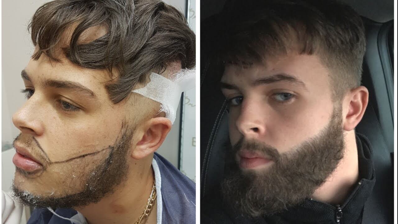 beard transplant