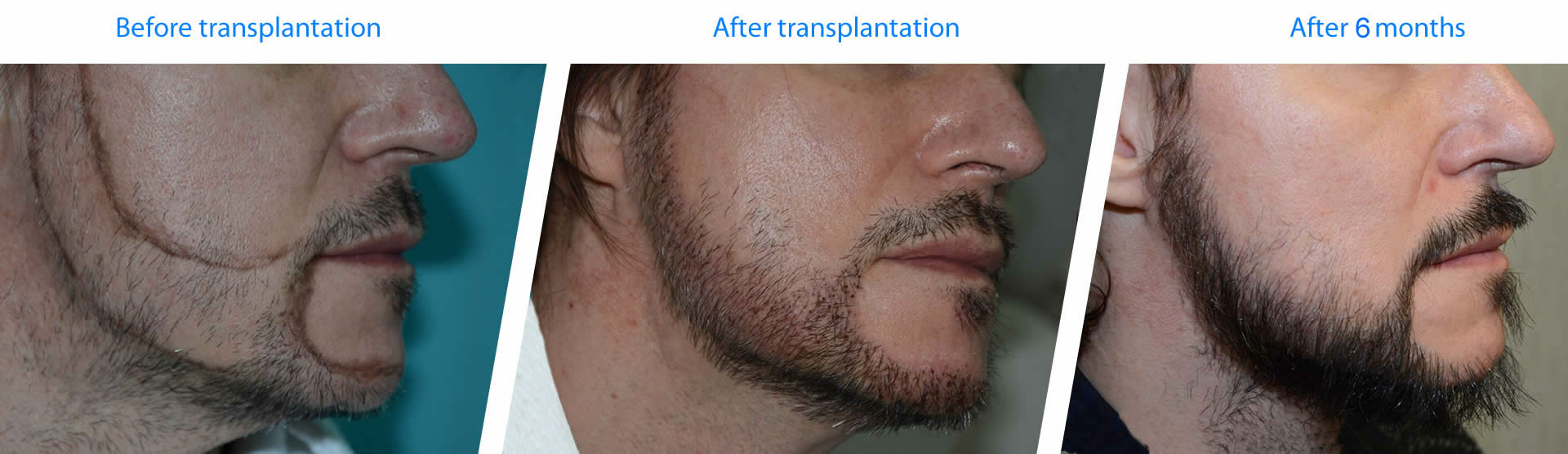 Beispiele und Ergebnisse für Barttransplantationen