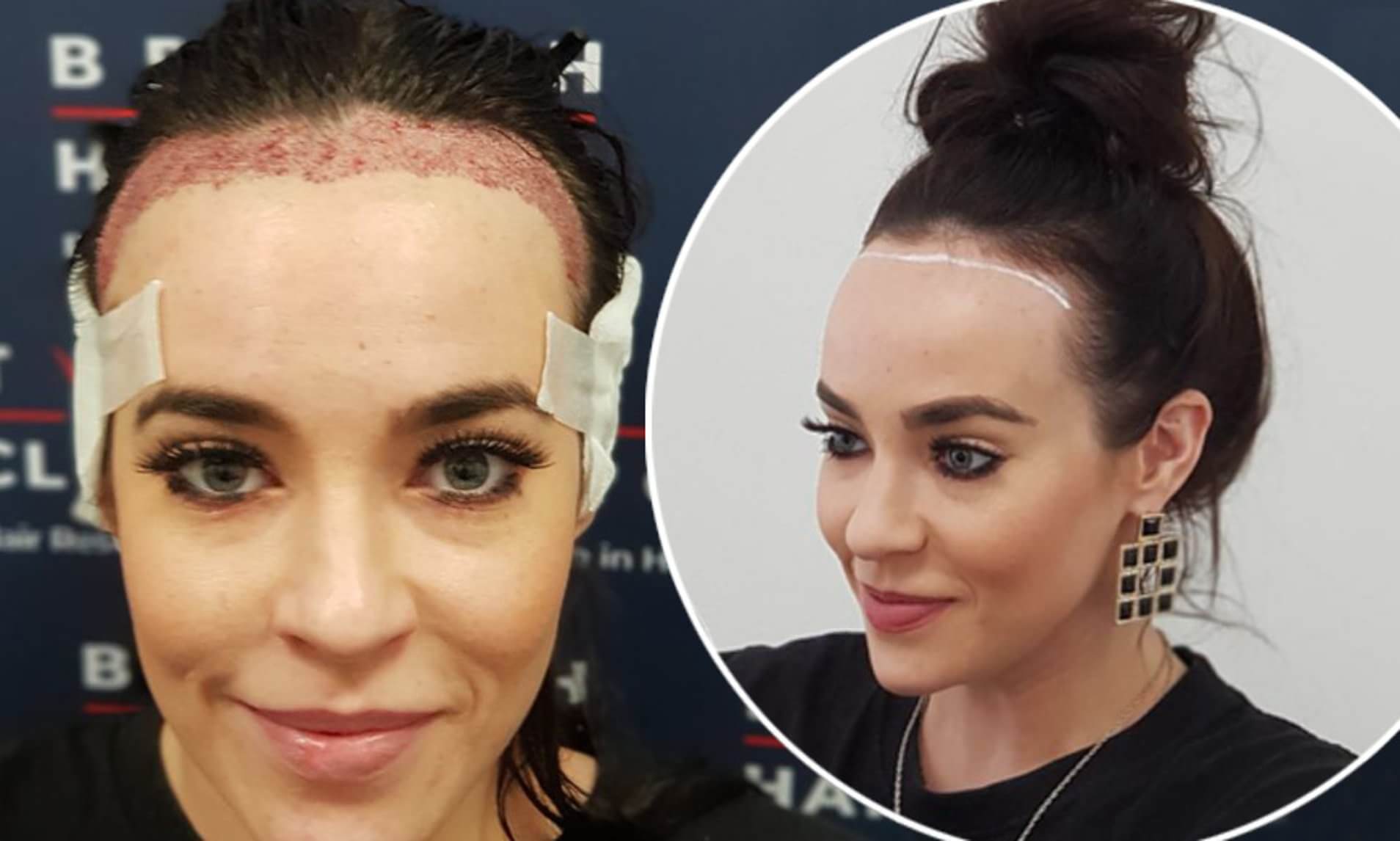 vor und nach der Haartransplantation