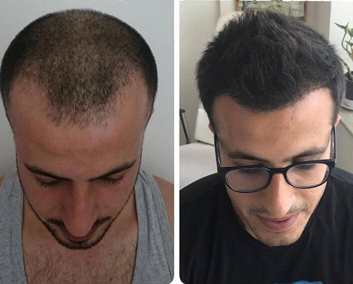 black hair man hair transplant before after