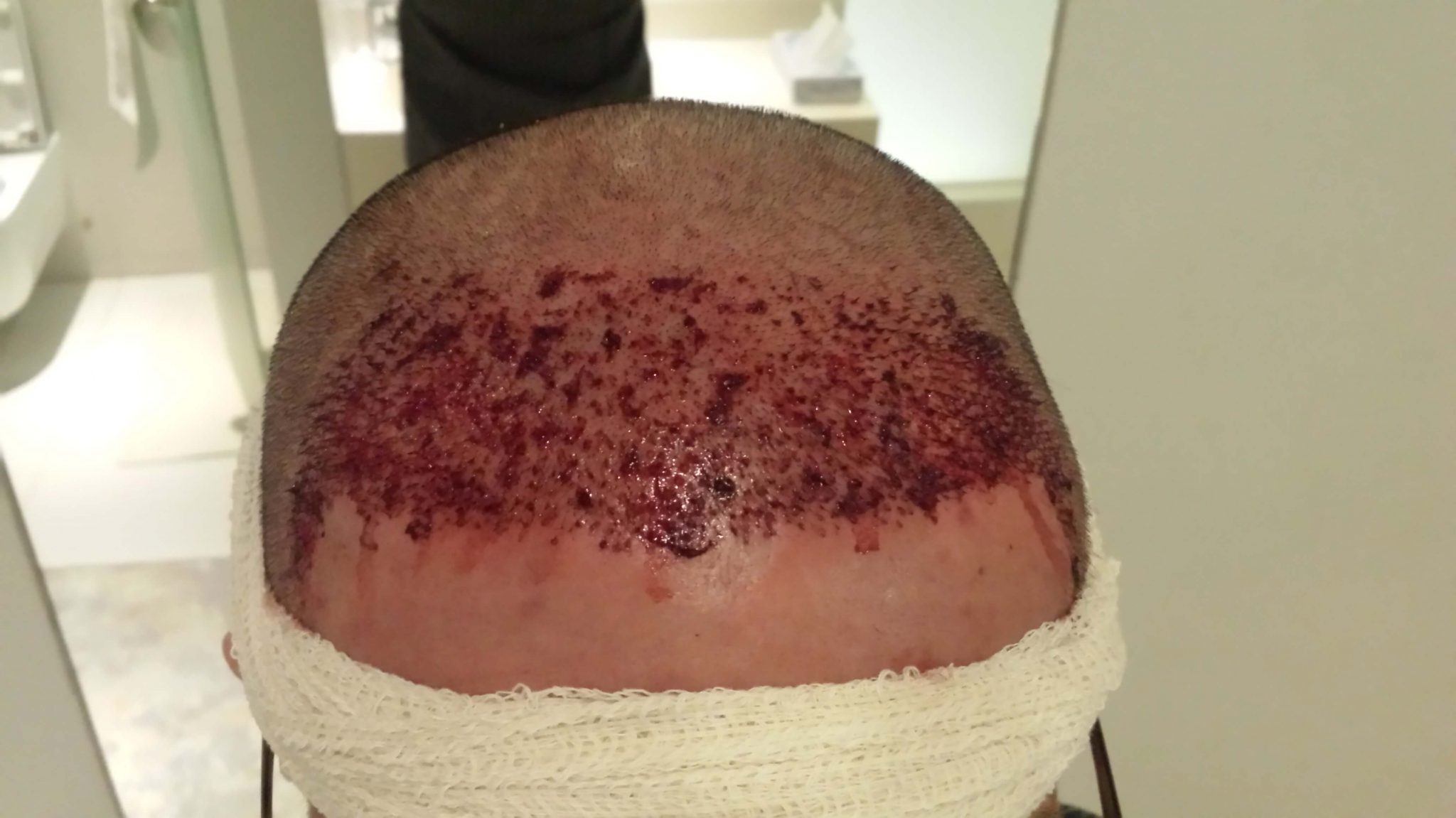 bleeding after hair transplant_1