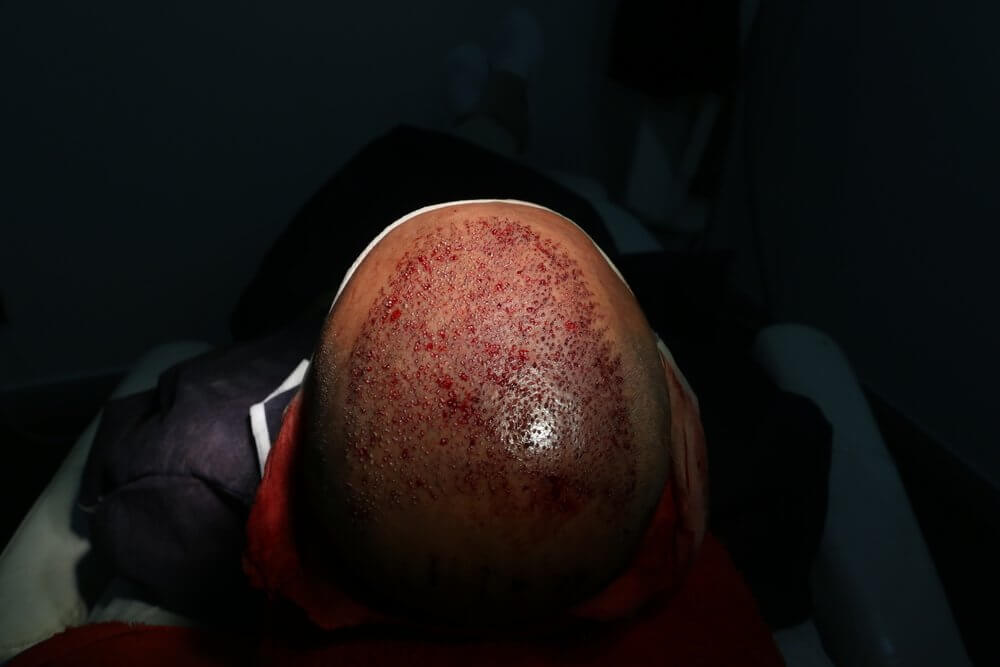 bleeding after hair transplant