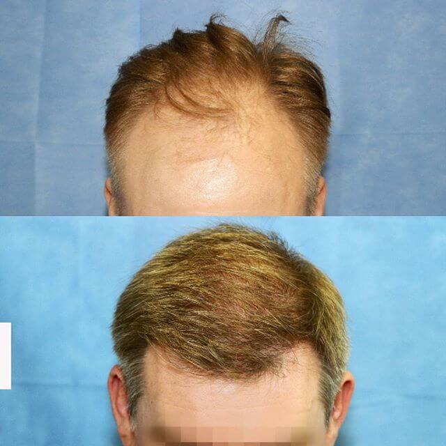 blonde hair hair transplant before after