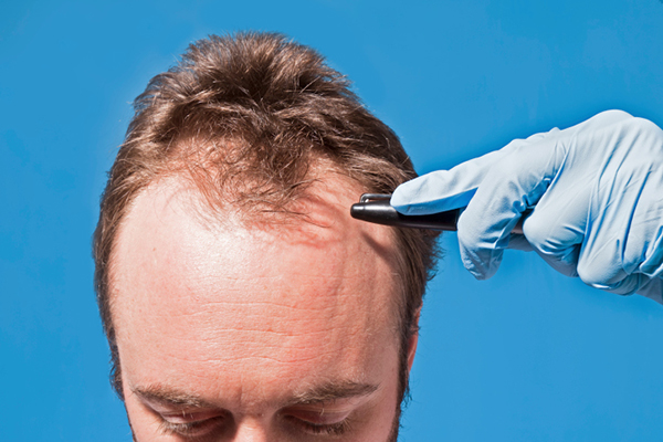 Ursachen für übermäßigen Haarausfall