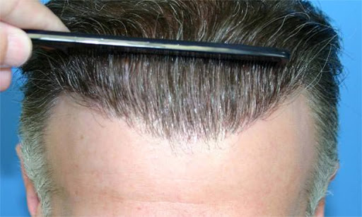 scegliere una clinica per il trapianto di capelli