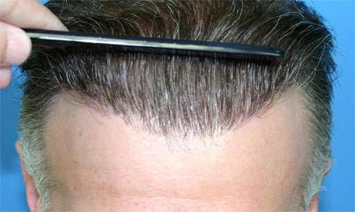 Wahl einer Haartransplantationsklinik