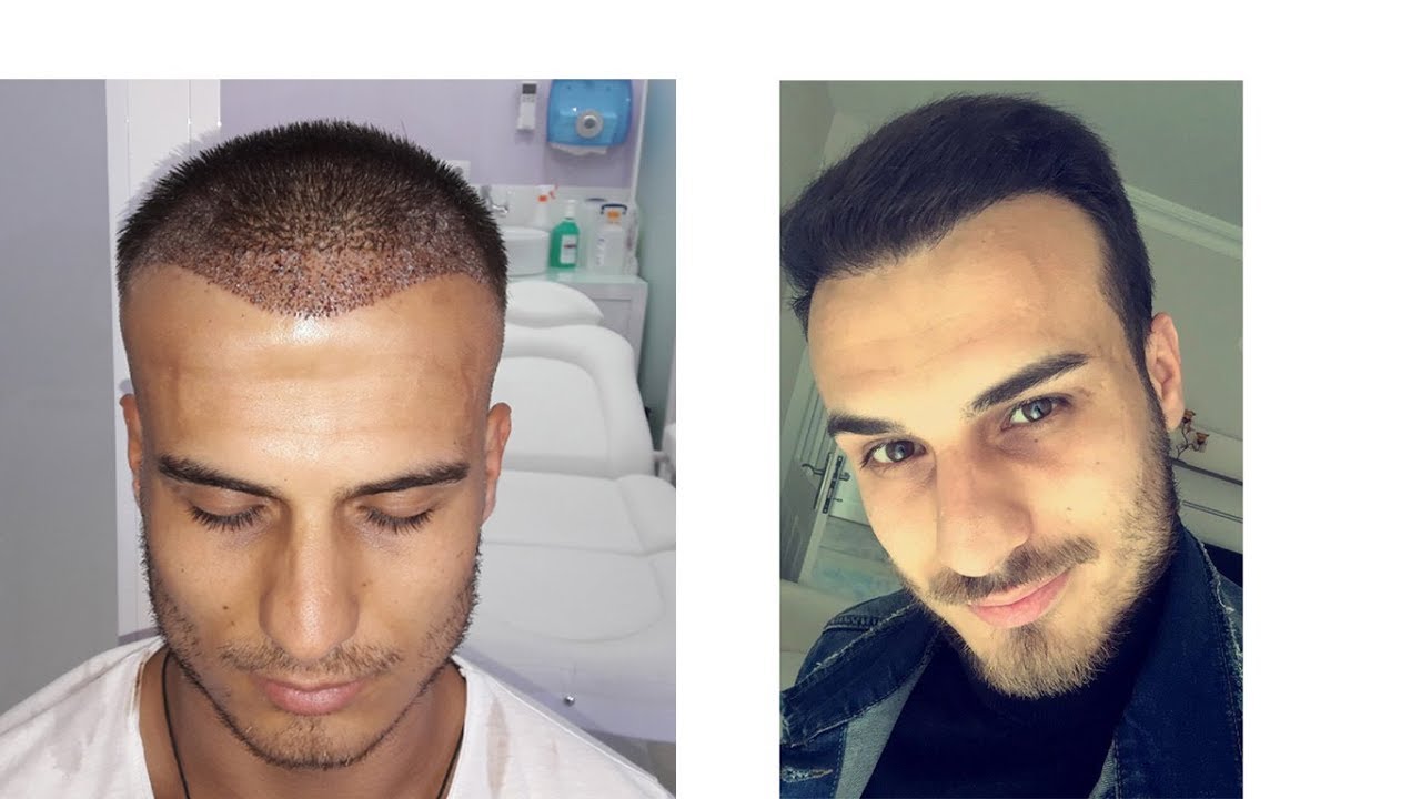 DHI Hair Transplant before after