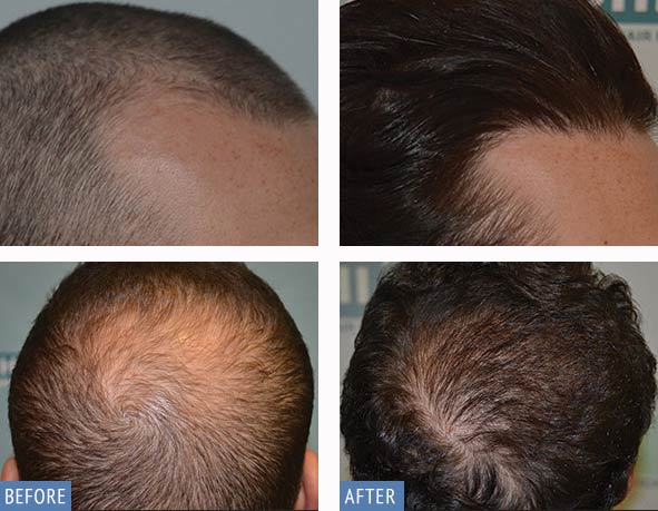 DHI Hair Transplant result