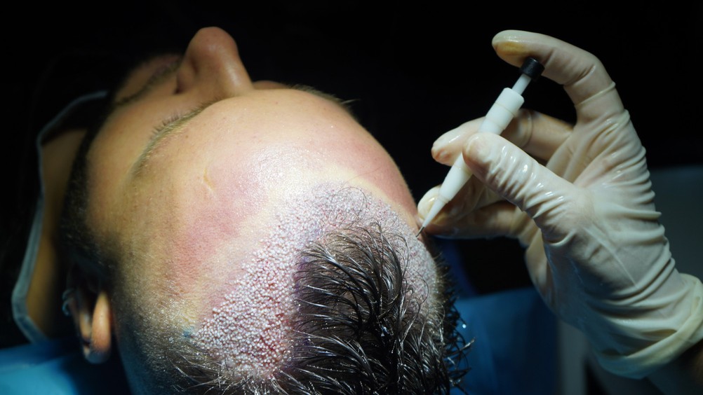DHI hair transplant results