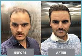 DHI hair transplantation results