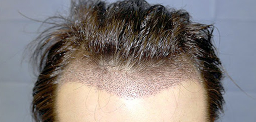 Trasplante de cabello DHI