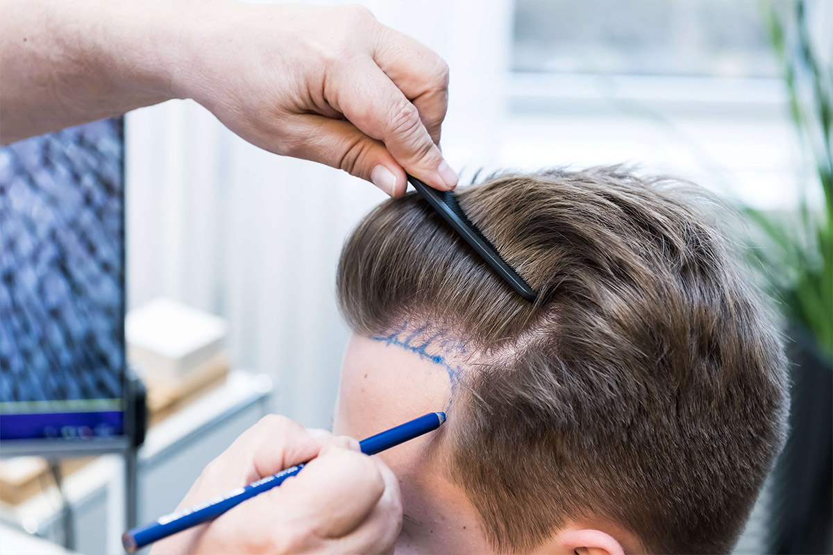 ¿Se cae el cabello trasplantado?