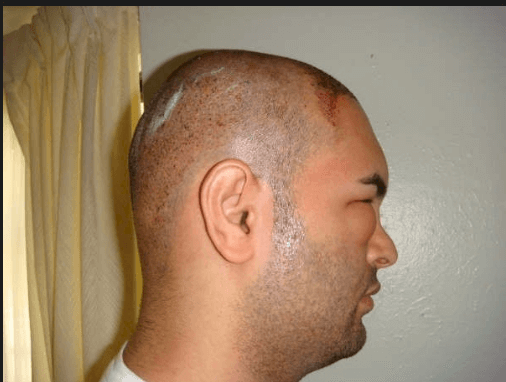 edema después del trasplante de cabello