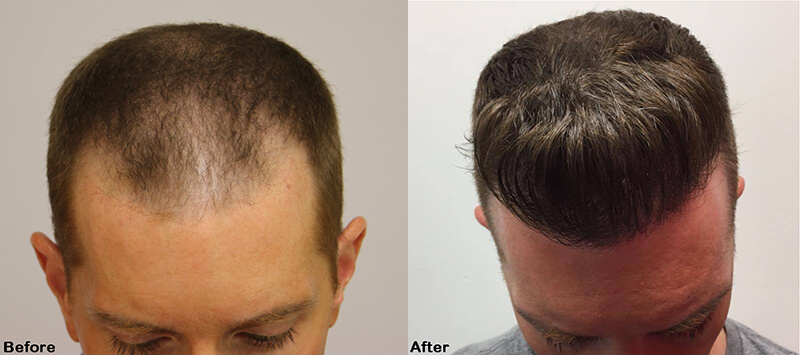 example hair transplant before after