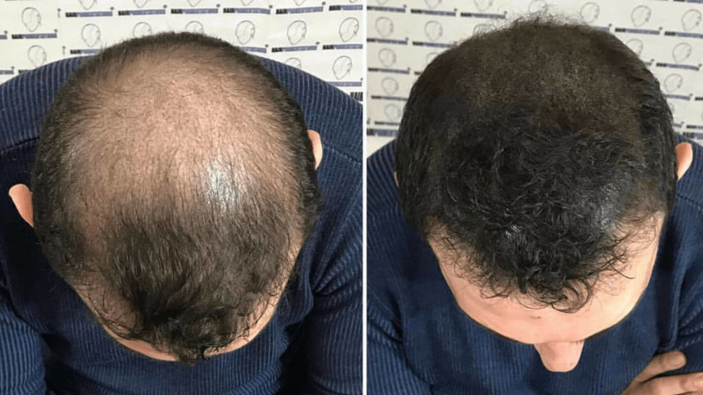 esempi di simulazione dei capelli