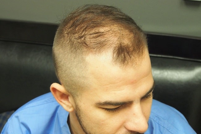 excessive hair loss