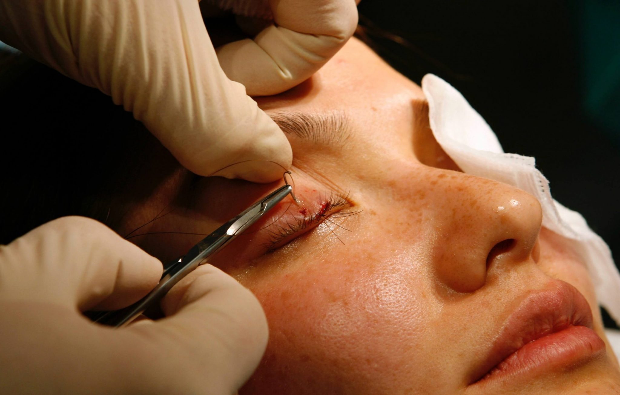 Wimperntransplantation