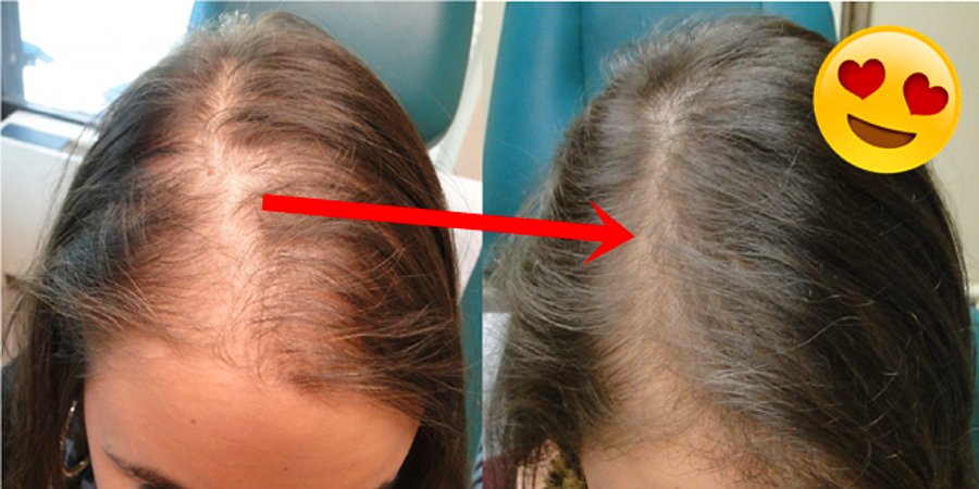 female hair loss before after 