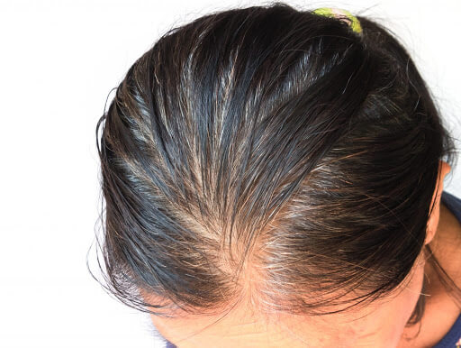 female hair loss