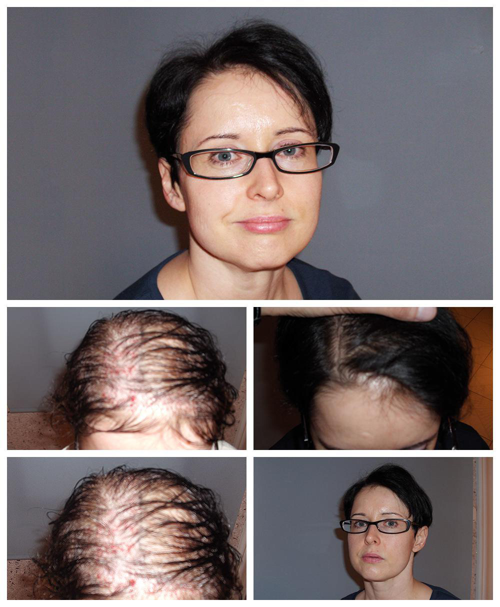 weibliche Haartransplantation_3