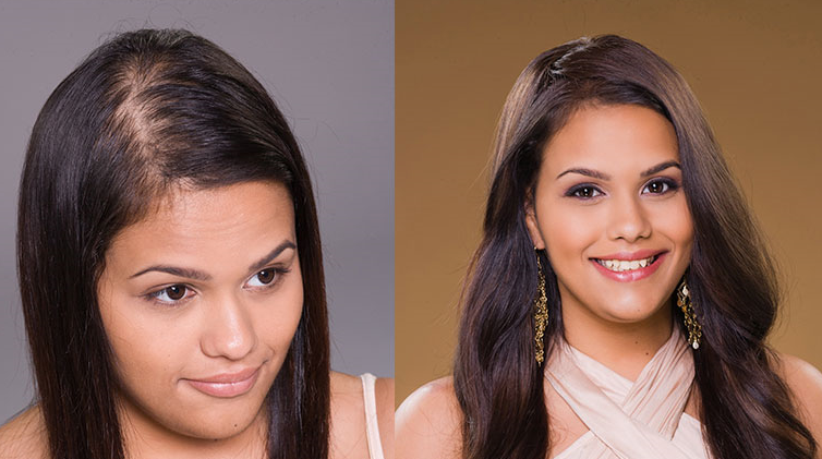 female hair transplant_4