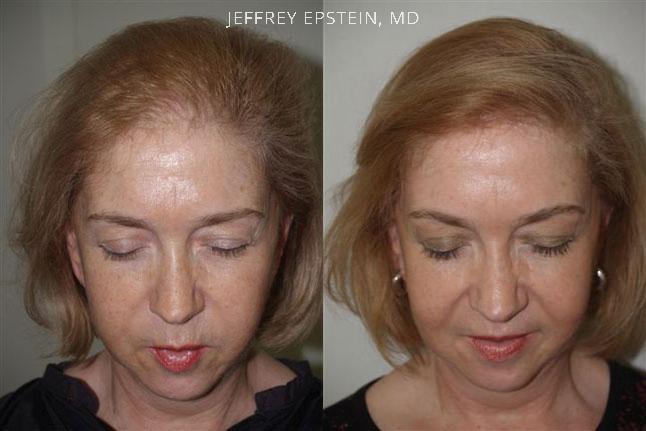 female hair transplant_7