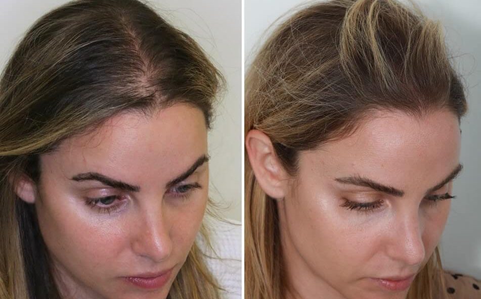 female hair transplant