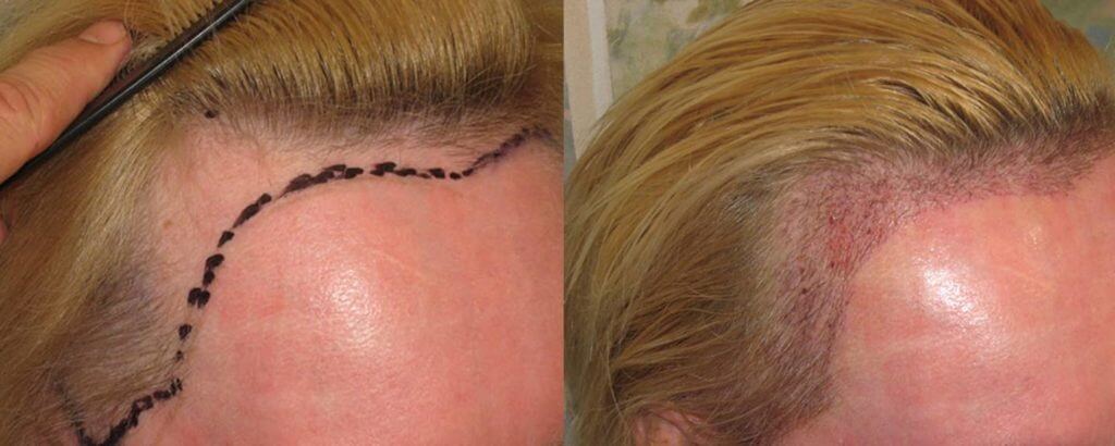 weibliche Haartransplantation