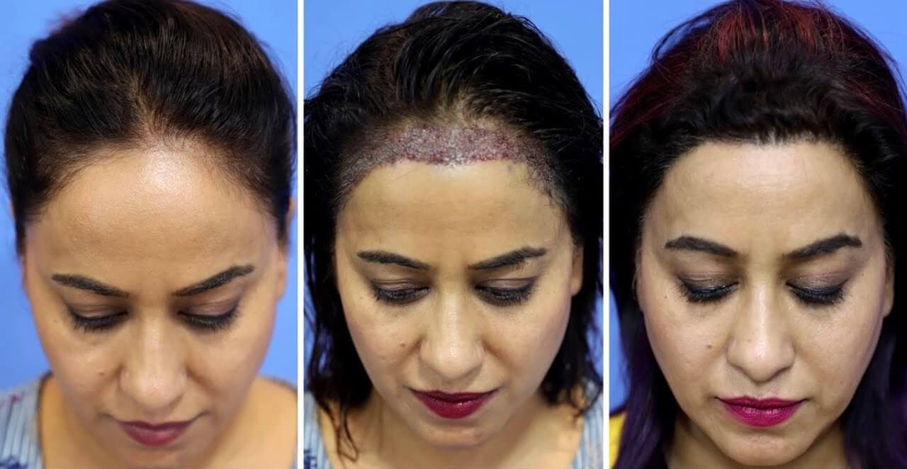 procedimiento de trasplante de cabello femenino